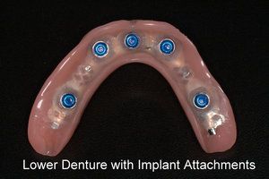 Lower Denture with Implant Attachments