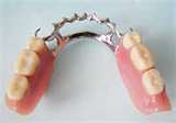 Partial Denture