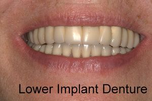 Woman smiling with lower implant denture installed