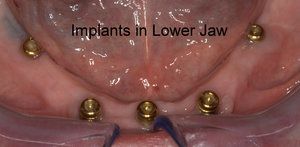 Implants in lower jaw